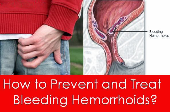 How to Treat Hemorrhoid Bleeding