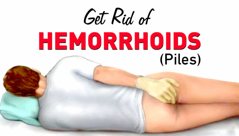 How to Get Rid of Hemorrhoids