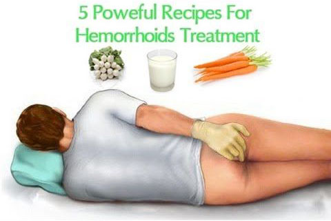 How to Treat Hemorrhoids at Home