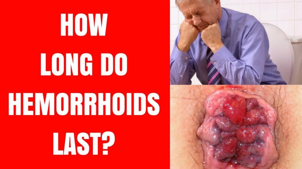 How Long do Advanced Hemorrhoids Last?