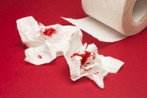 Rectal Bleeding Causes | Bleeding Hemorrhoids