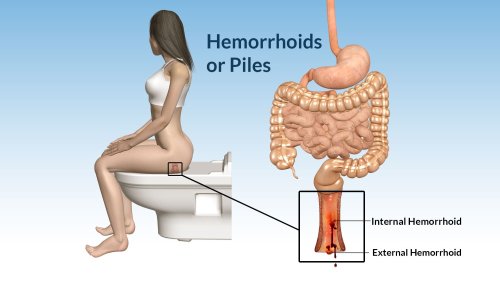 Internal Hemorrhoids